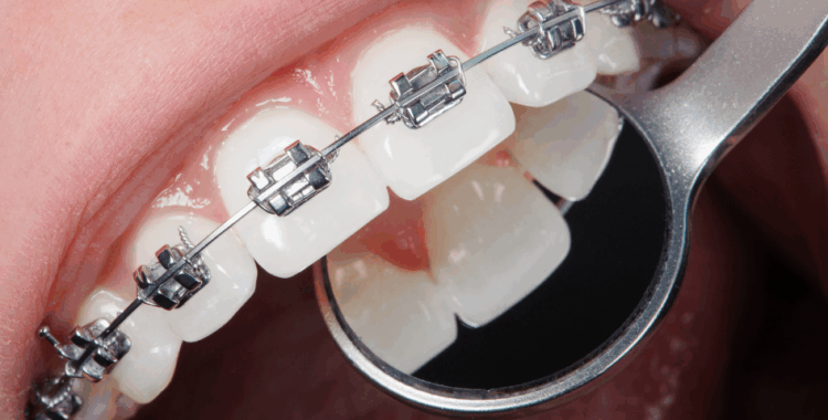 Când este necesar tratamentul cu aparat dentar?