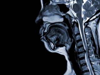 Ce ar trebui să cunoști despre mielopatie, care este legătura între aceasta și hernia de disc