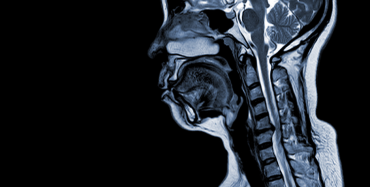 Ce ar trebui să cunoști despre mielopatie, care este legătura între aceasta și hernia de disc