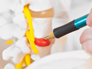 Operația de hernie de disc cu tehnica Ultra Minim Invazivă – care sunt avantajele?